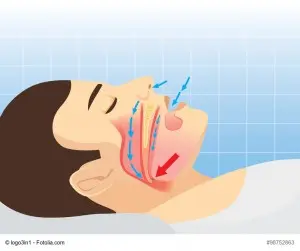 cause of snoring