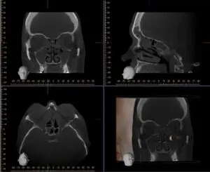 CT scan of the sinus