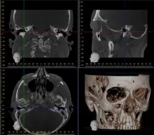 CT scan of the temporal bone