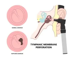 medical diagram of a ruptured eardrum.